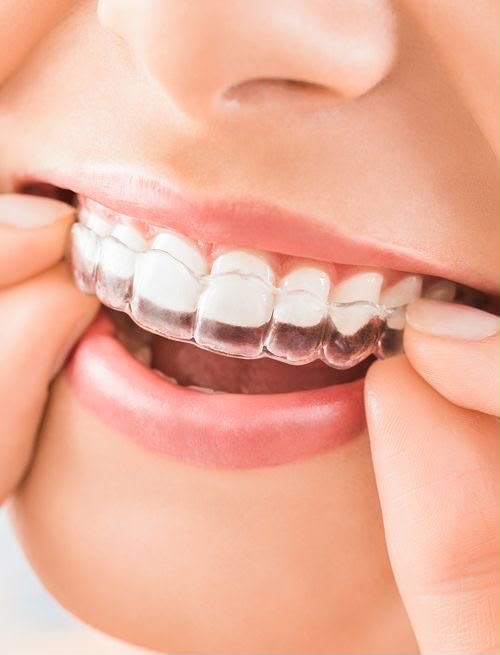 Clear Aligners & Braces